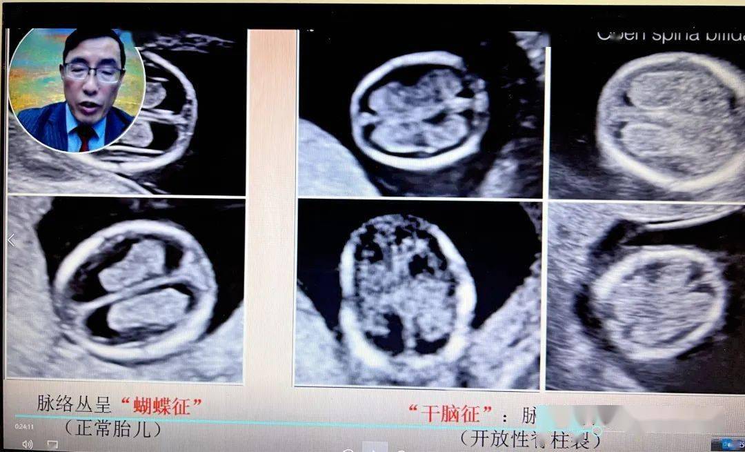 早孕期脉络丛周围脑脊液少要想到开放性脊柱裂可能