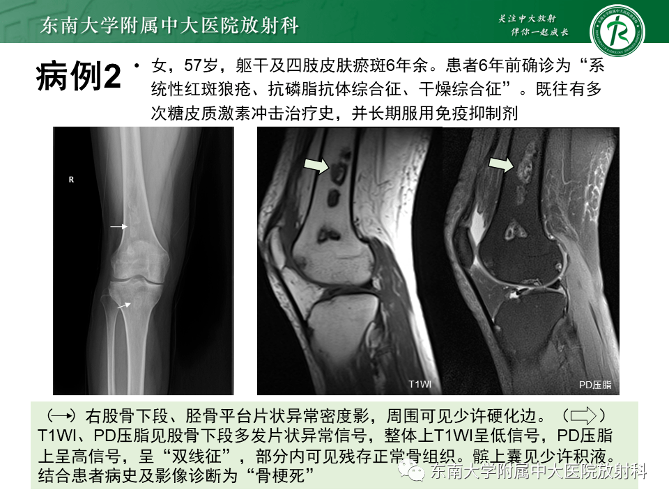 骨梗死影像表现