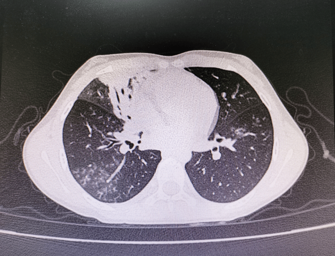 大叶性肺炎症状图片
