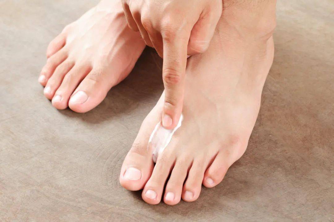 夏季湿热,如何防止脚癣频发?_真菌_治疗_皮肤