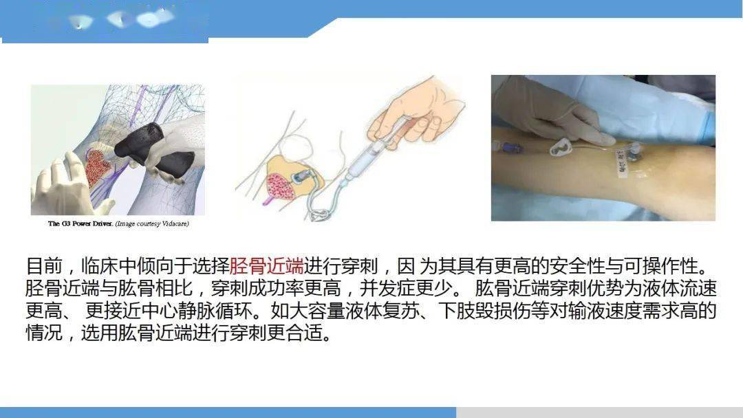 【ppt】永不塌陷的生命通路-骨髓腔输液技术_护理_微信_中卫