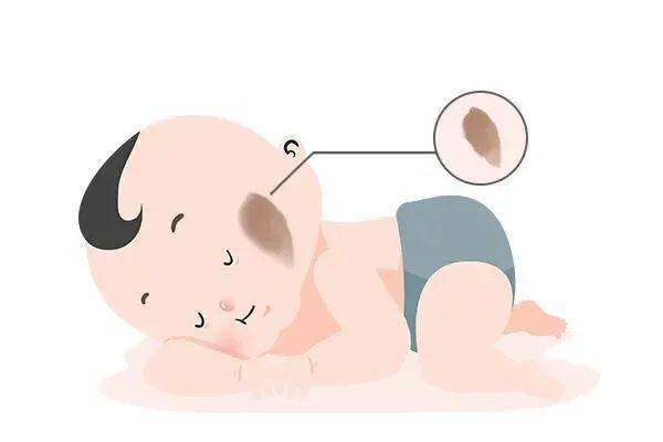 色素型的包括咖啡斑,太田痣,蒙古斑,伊藤痣等;胎记一般分为色素型和