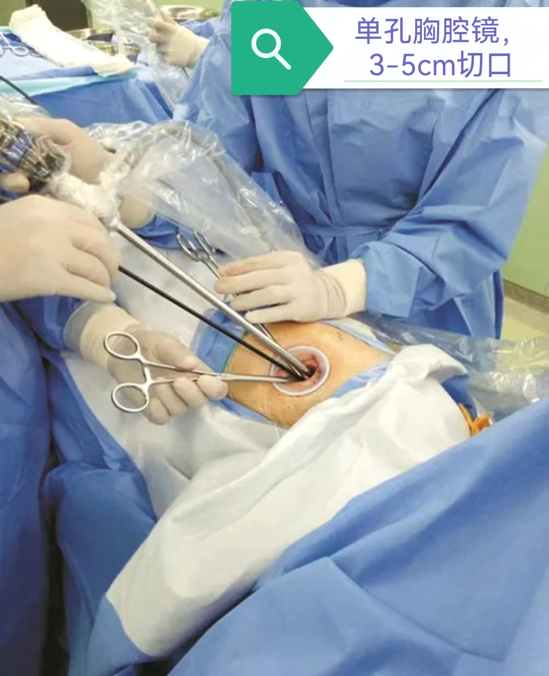 团队成功独立完成医院首例单孔胸腔镜下肺叶切除术_手术_治疗_市二院