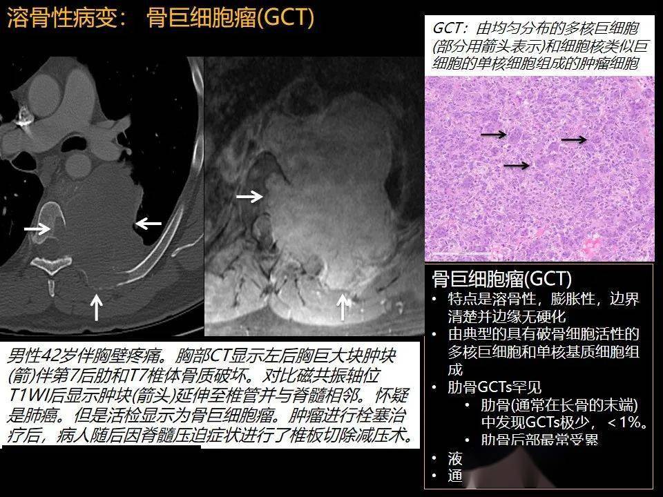 rsna精选内容肋骨肿瘤肿瘤样病变及获得性非创伤性病变的影像诊断基本