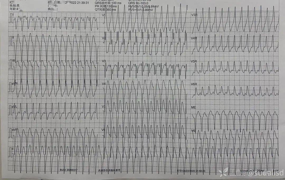 8份真假分支型室速心电图你能正确识别吗