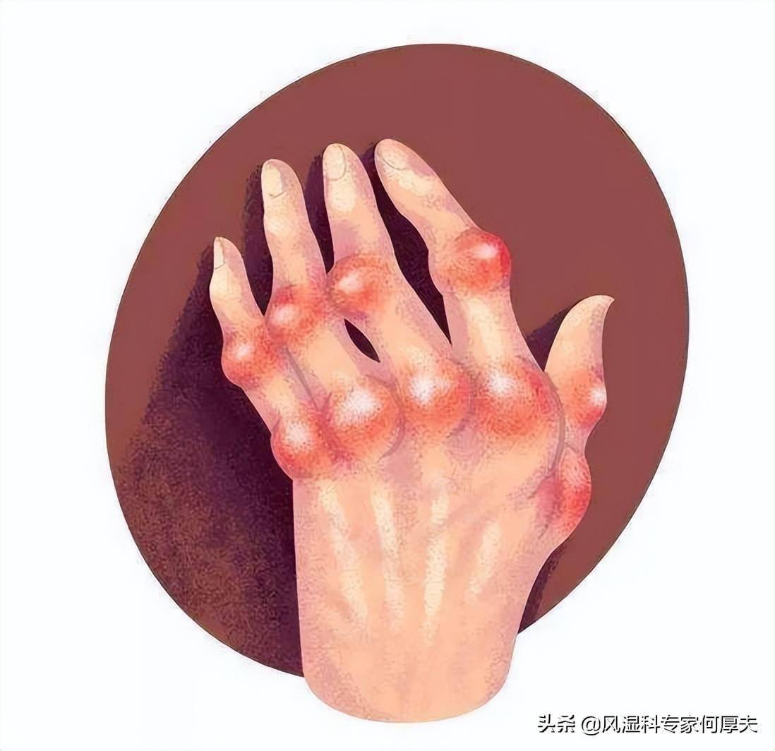 风湿关节痛为什么找上你?怎么祛除?