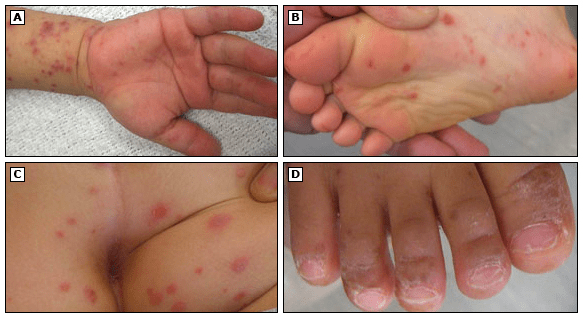 5小時接診51個兒科醫生手足口皰疹性咽頰炎爆發期到了要警惕