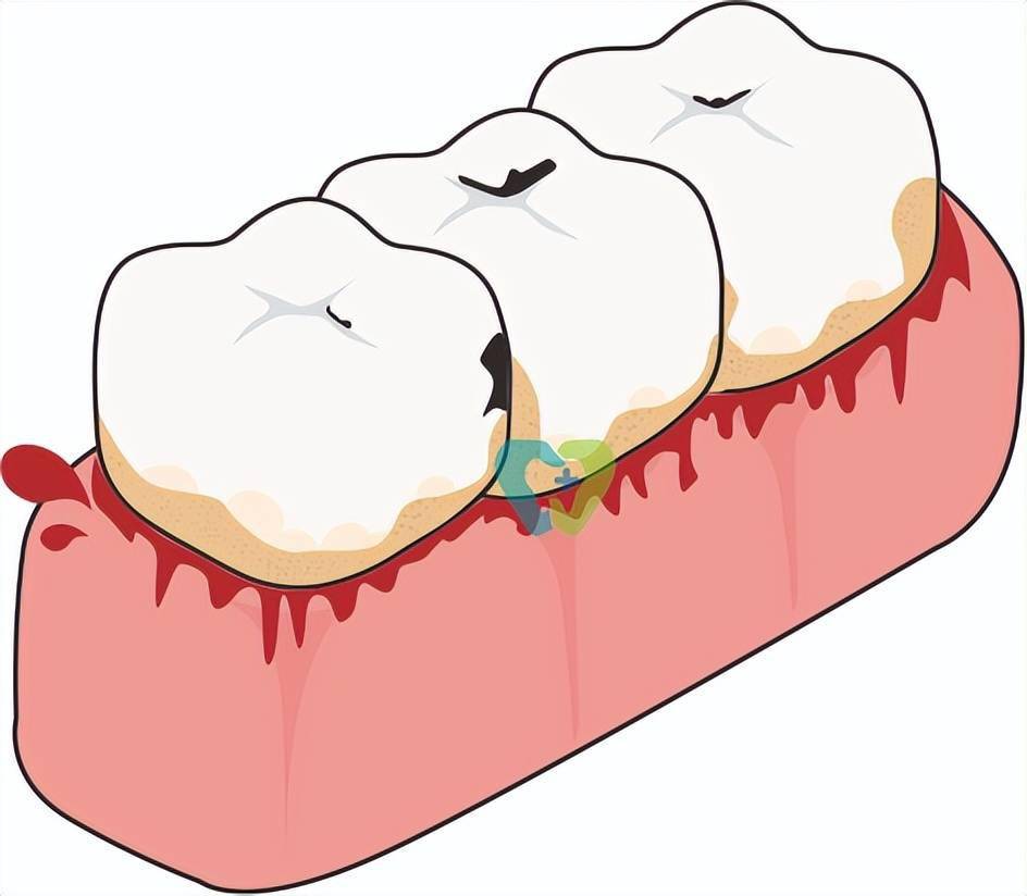 牙齦炎或牙周炎引起的牙齦出血牙齦經常出血怎麼辦?