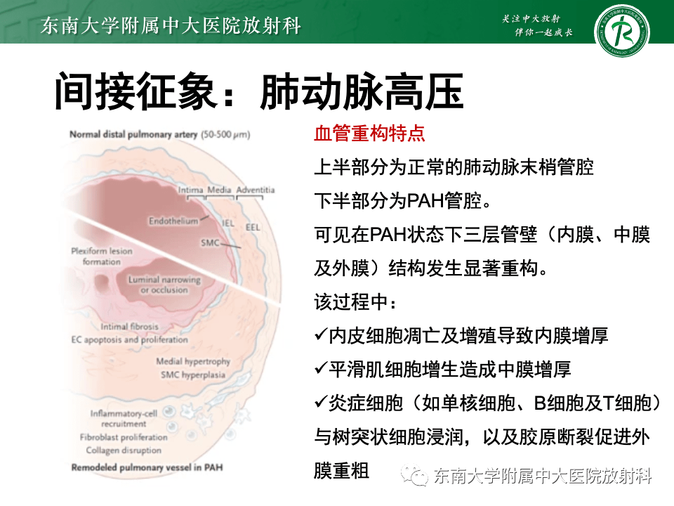 主動脈弓離斷