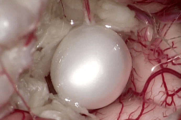 颅内胆脂瘤,是一种缓慢生长的良性肿瘤,好发于颅底的蛛网膜下腔区域.