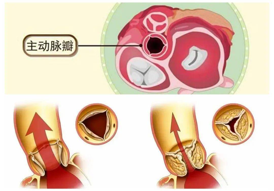 主动脉瓣上缩窄图片