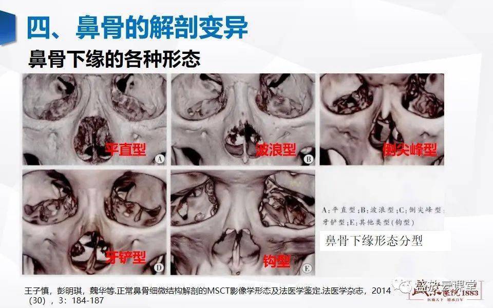 鼻骨正常ct解剖变异与骨折