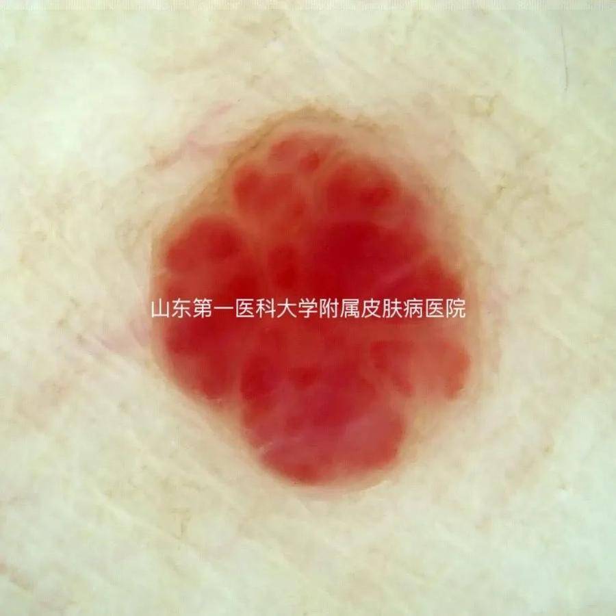樱桃样血管瘤的皮肤镜表现:可见境界清晰的红色或紫红色腔隙