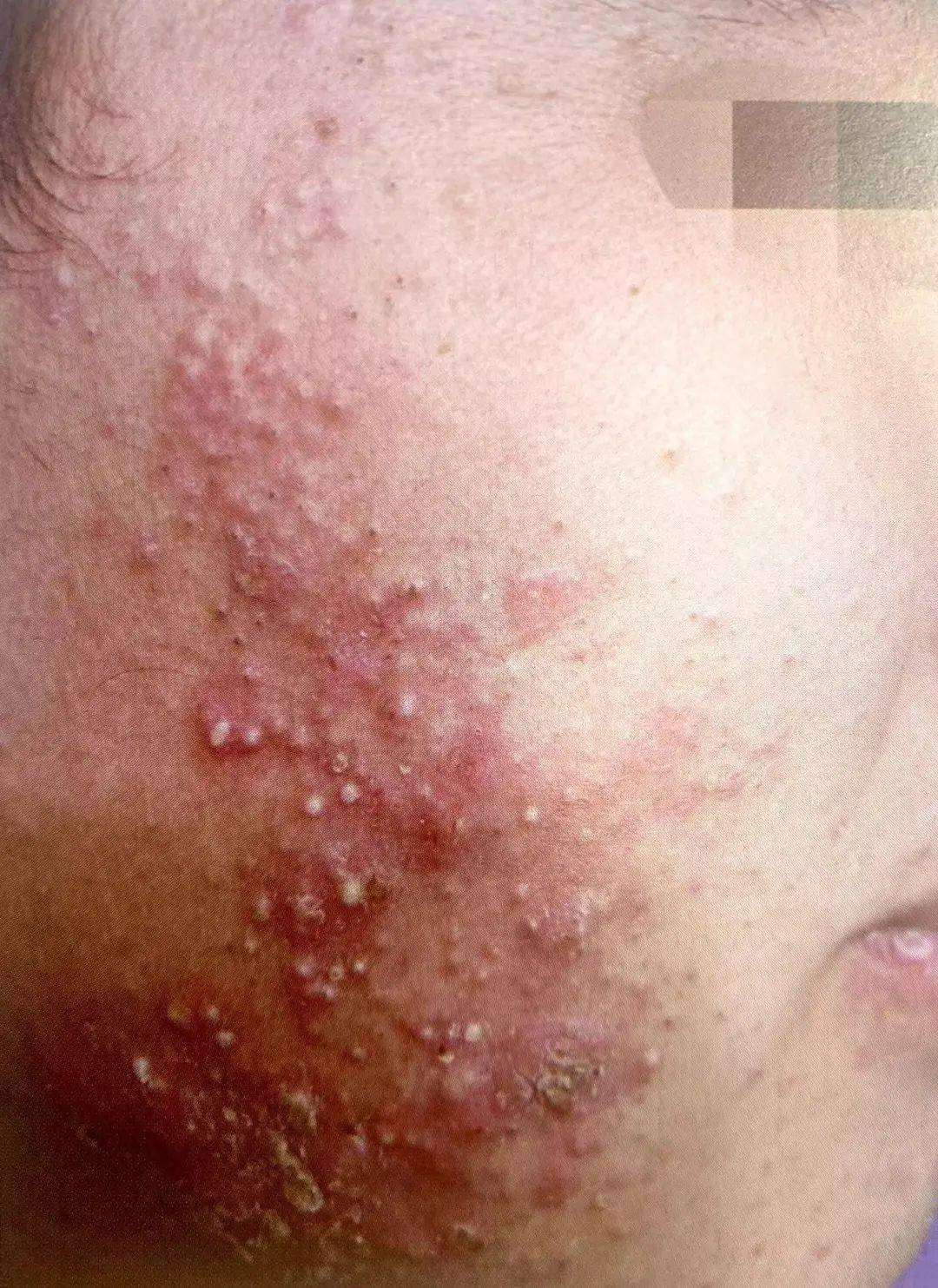 身上的这种小红点是病毒感染,小心越长越多_危害_病因_皮肤