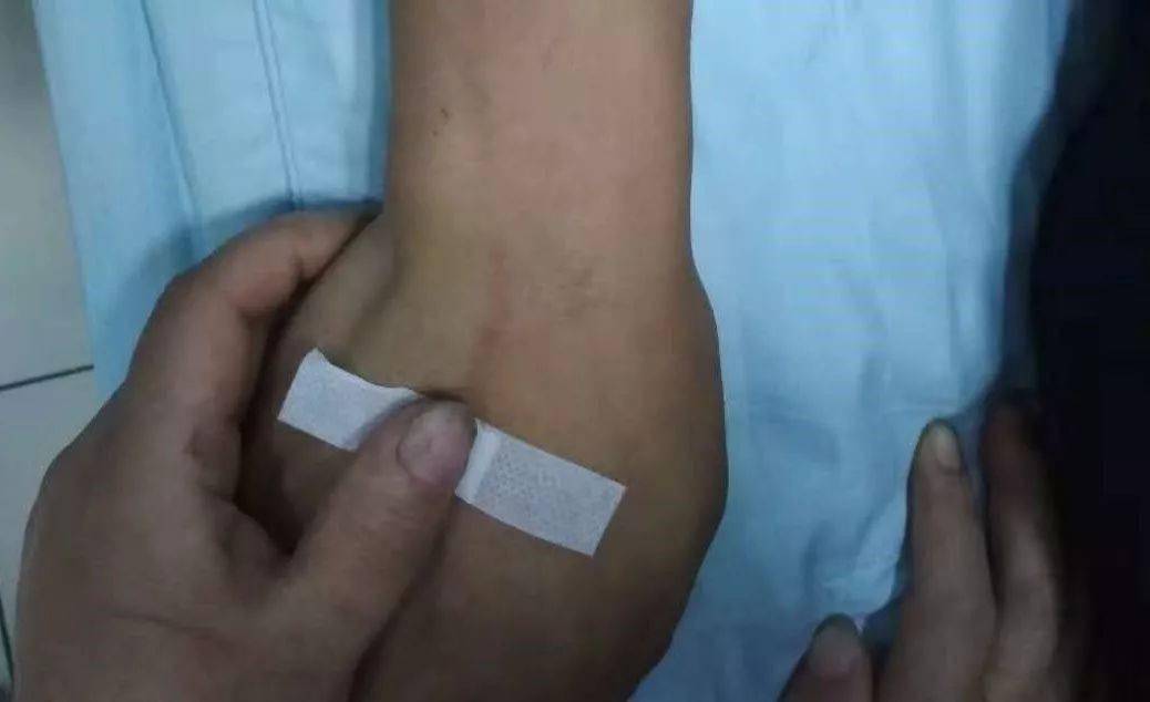 拔针时才发现太危险了