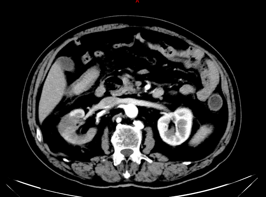 诊断明确:肾梗死!