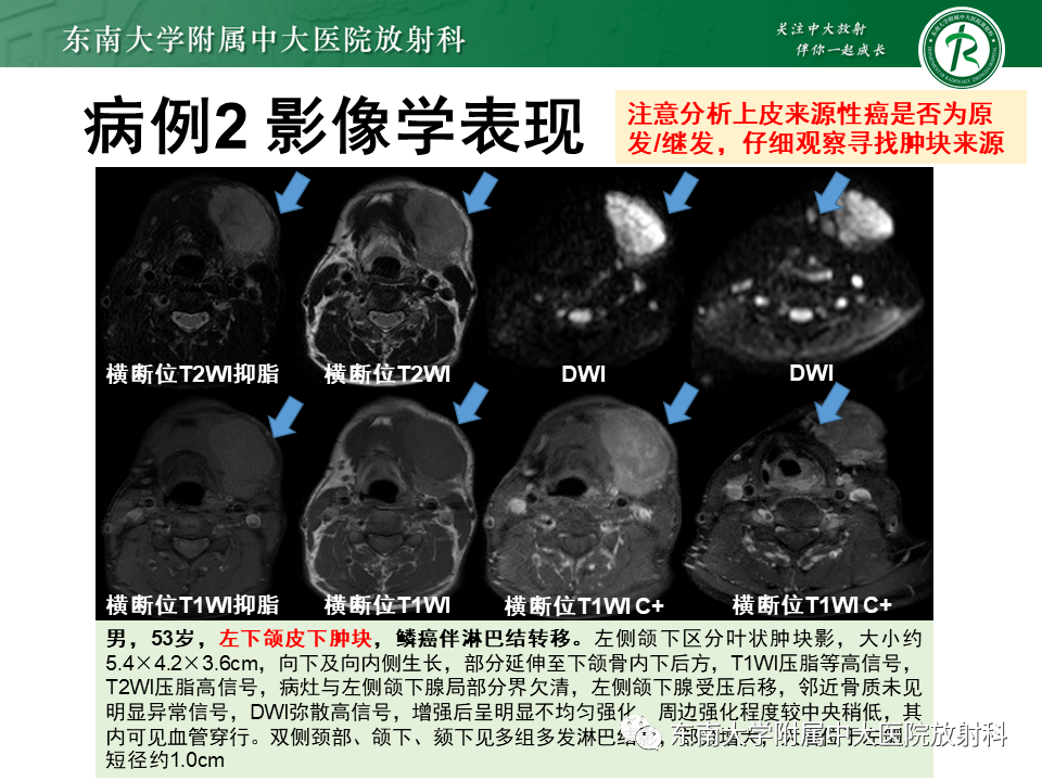 颌面部病变 横纹肌肉瘤_全网_影像_解剖图