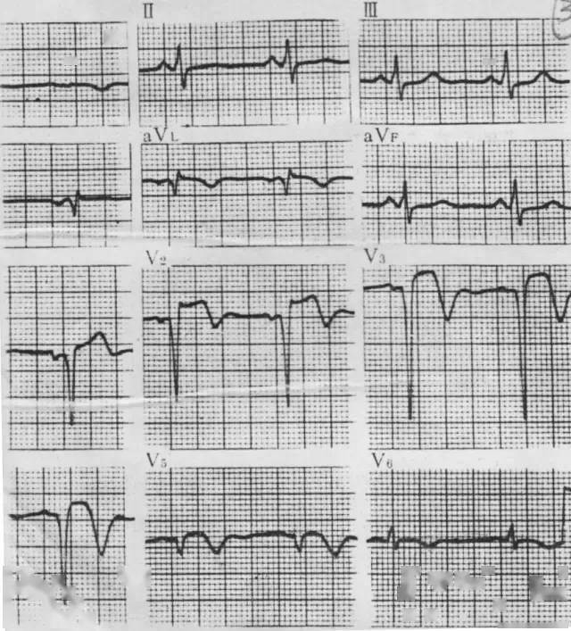各型冠心病的心電圖鑑別診斷這篇講的很詳細