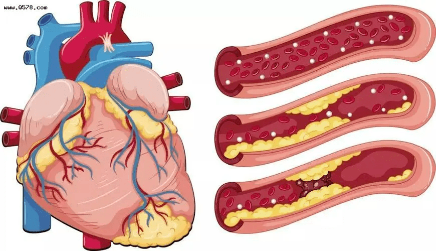 冠心病分类图片图片