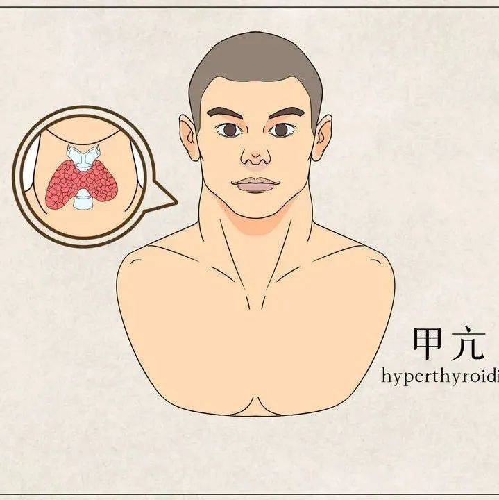 健康科普 | 尽早识别甲亢,安全度过夏季“亢奋”期_甲状腺_患者_症状
