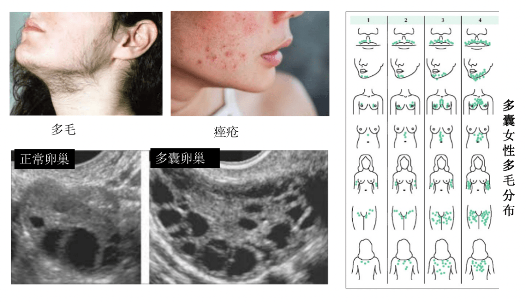 卵巢没有 多囊 却被诊断多囊卵巢综合征 高雄 激素 疾病