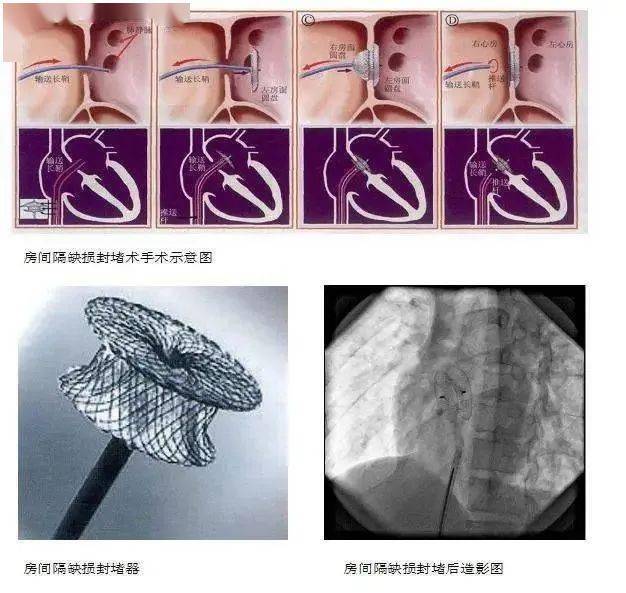 让孩子远离儿童先天性心脏病这些是关键