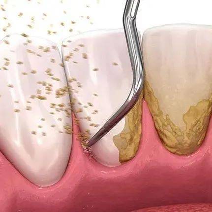 洗牙都不能解決的結石?醫生:那就用這個刮一刮_牙齒_牙周_牙齦