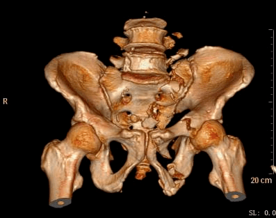 梁某,男性,68岁,诊断:多发性骨盆骨折,骶骨骨折,左侧耻骨上,下支骨折