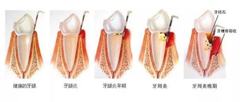 牙龈出现白脓包,你以为只是发炎吗?