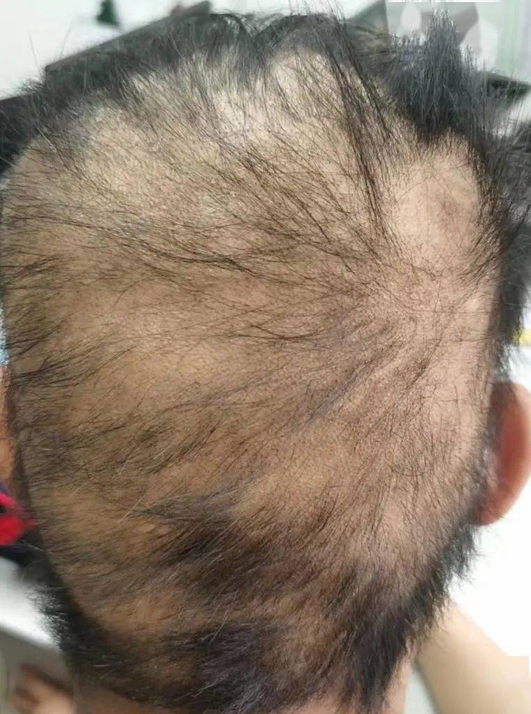 17岁高中生患重症斑秃这些生活习惯害了他医生此病越来越多最好趁早