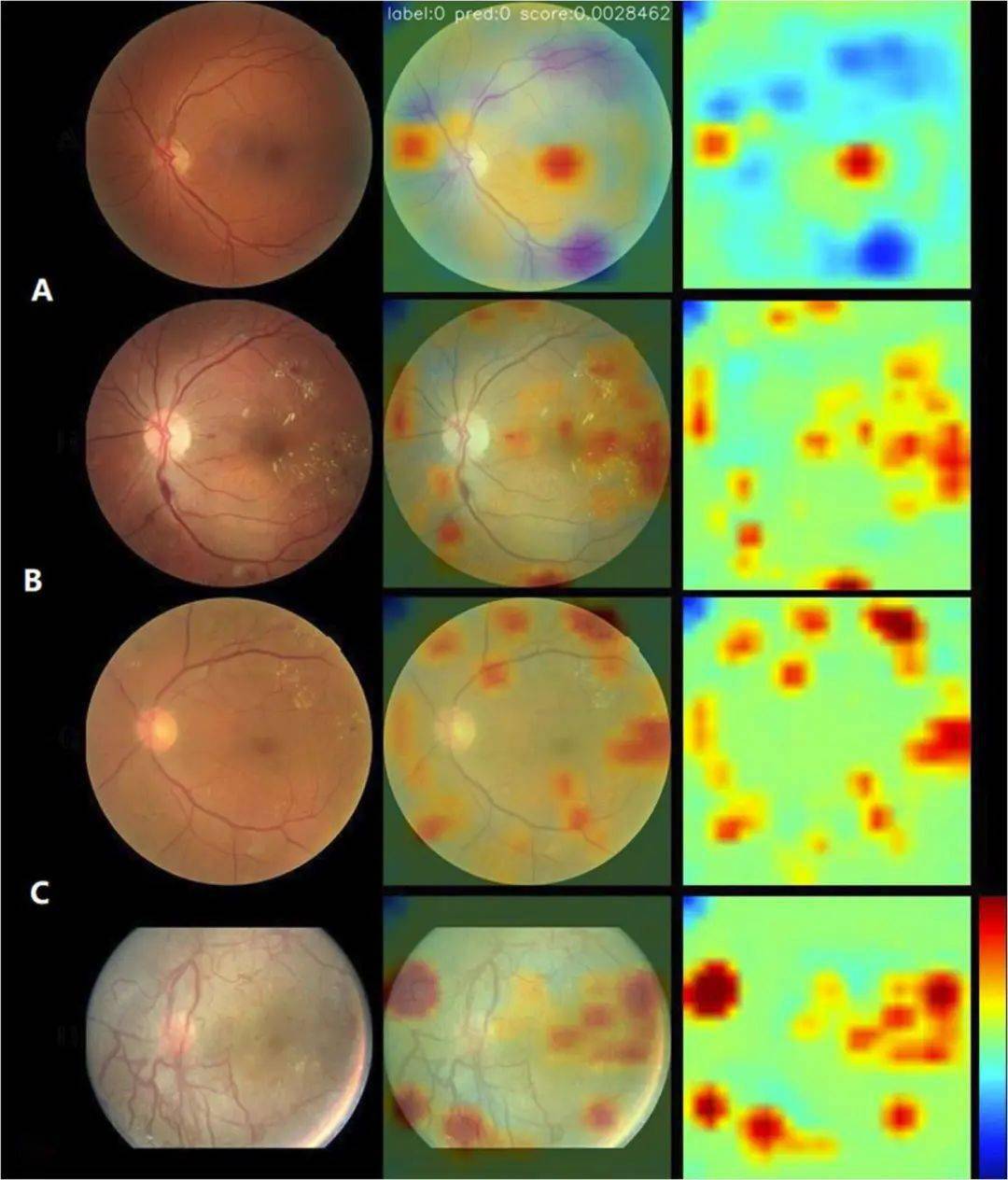 协和眼科研究系列报道重症糖尿病视网膜病变的智能识别