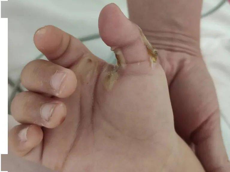 宝宝家中被电击手部烫伤医生换药好心疼