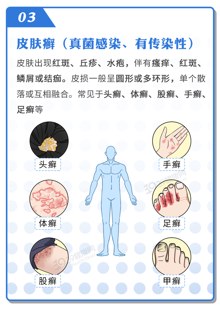 外阴疱疹感染的原因图片