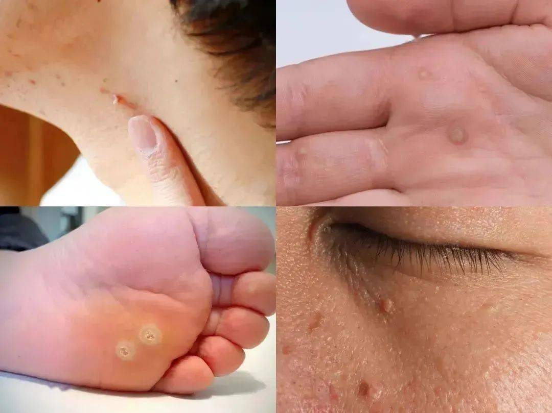 4. 以及最令人害怕的生殖器疣——尖锐湿疣(俗称菜花).3.