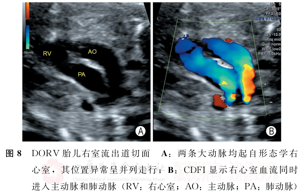 胎儿法洛四联症和右室双出口超声检查中国专家共识2022版二