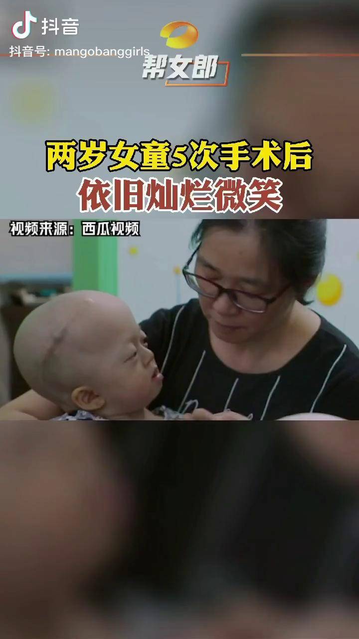 两岁女童5次手术后依旧爱笑煜宝身患狭颅症等多种疾病但小女孩依然