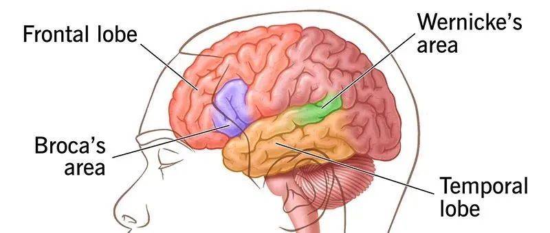 造成失语症原因有哪些?_语言_#Broca_Aphasia