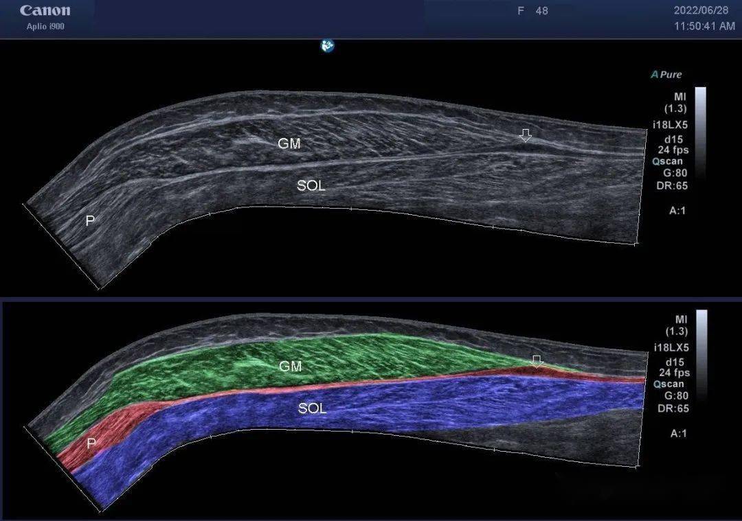 美图欣赏61网球腿(跖肌腱撕裂)_超声_血肿_箭头