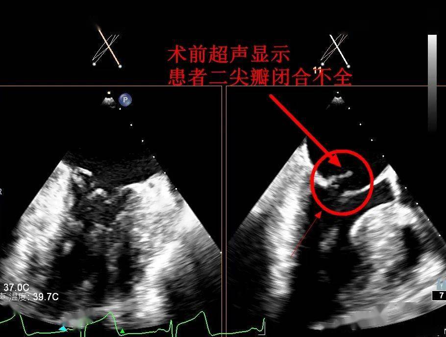 二尖瓣關閉不全是常見的心臟瓣膜病,在病情嚴重時患者會感到無法平臥