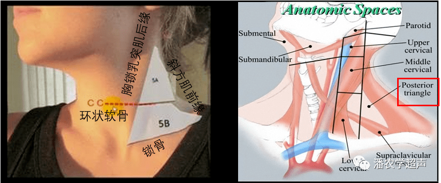 v區-椎旁淋巴結和頸橫淋巴結(頸後三角淋巴結):頸後三角:位於胸鎖乳突