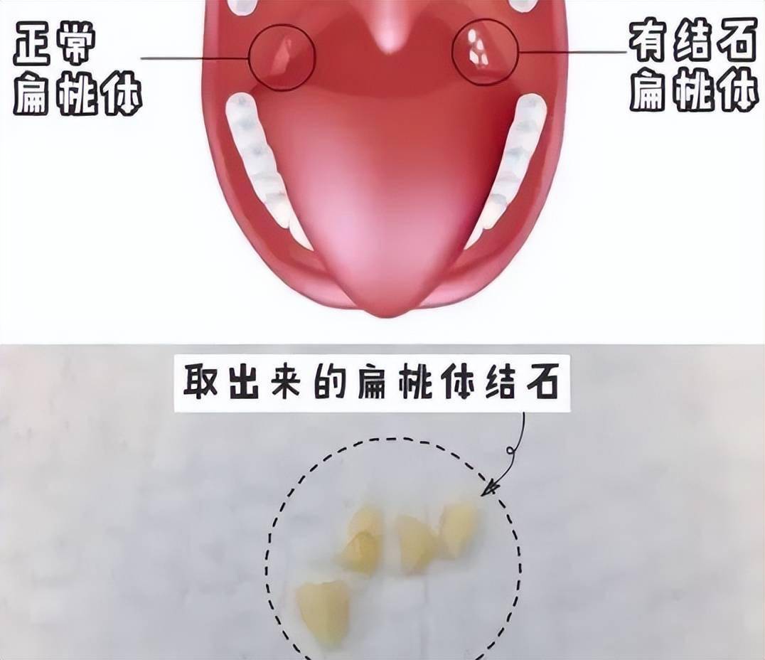 嘴巴里结石在哪个部位图片