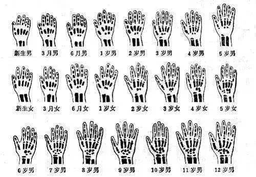左手骨龄报告单怎么看图片