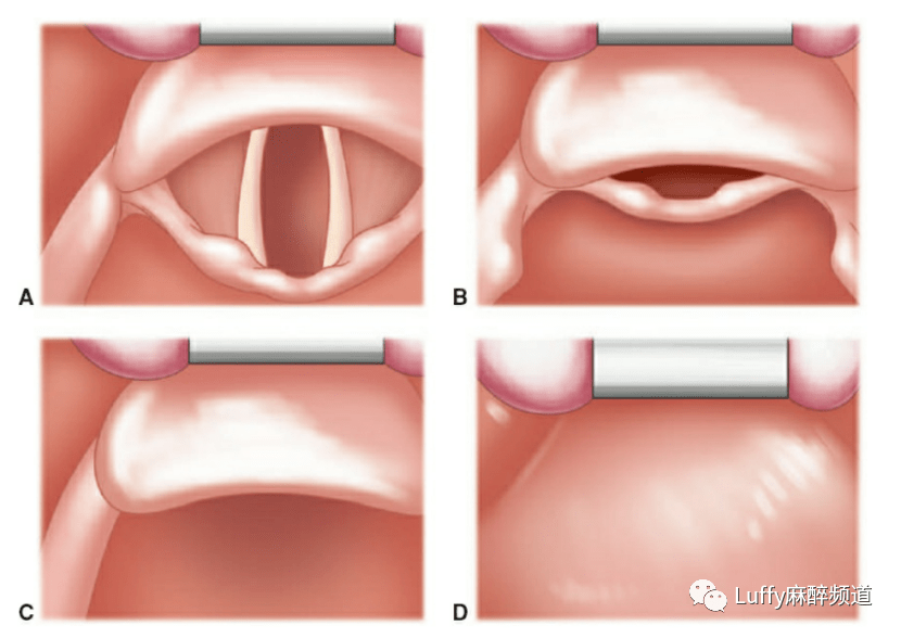 气管插管声门解剖图图片