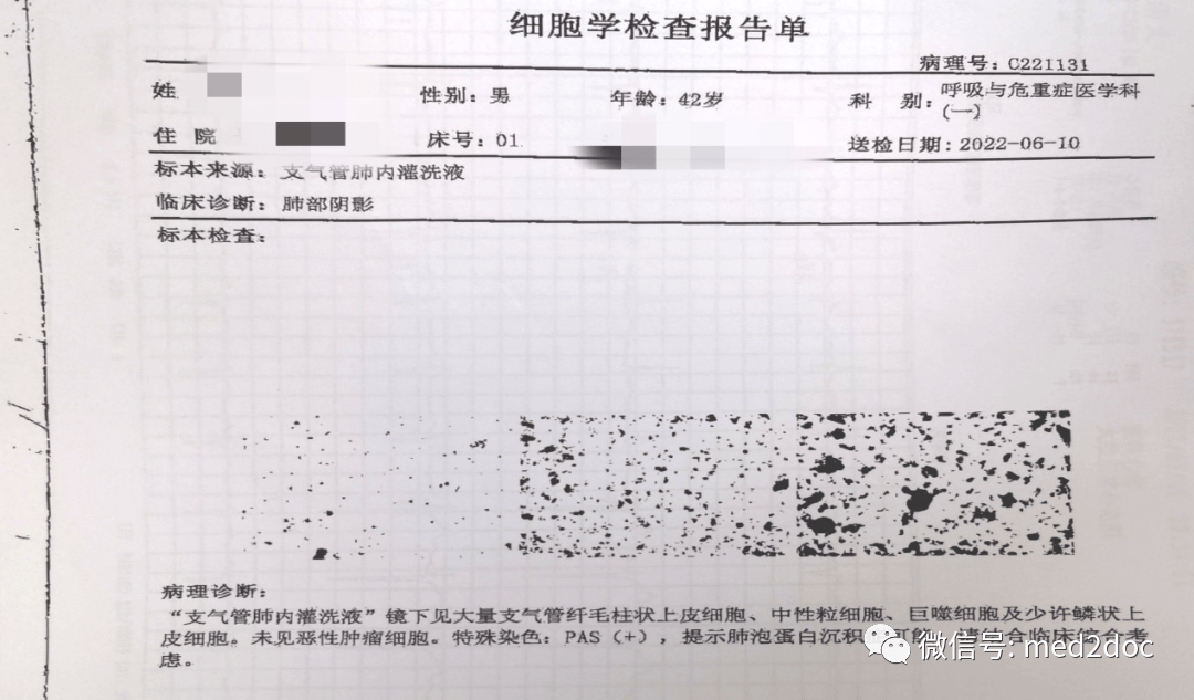 罕见42岁男子一次受凉后出现咳嗽咯黄白色痰症状肺里洗出17升牛奶