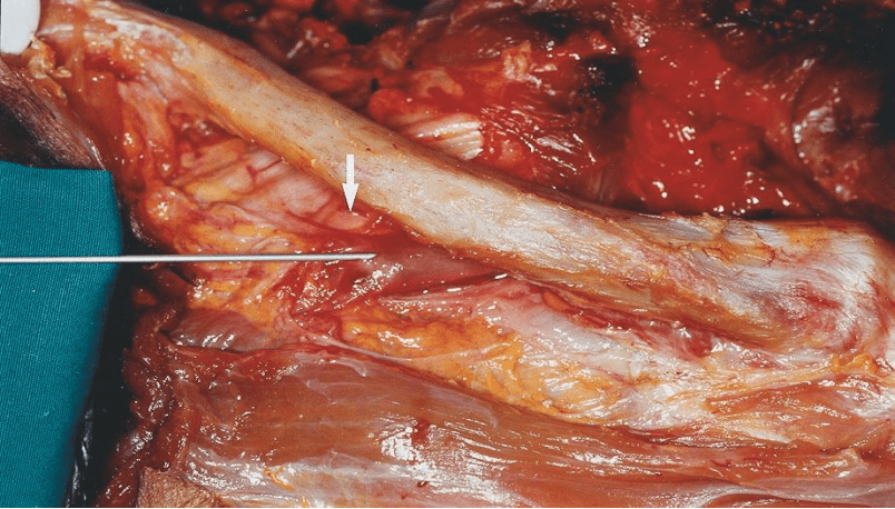 锁骨下动脉置管图片