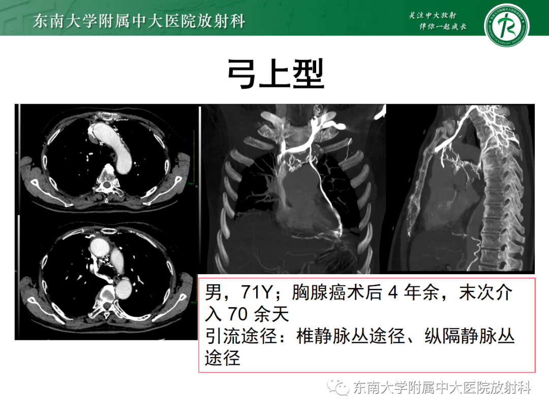 上腔静脉ct解剖图片