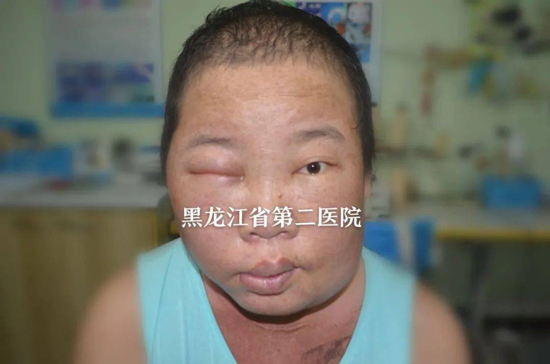 淋危不惧肿有办法黑龙江省第二医院为您讲解淋巴水肿的康复治疗