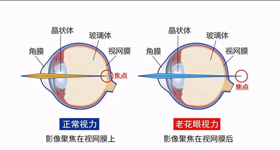 老花眼的验光方法_视力_光度_附加