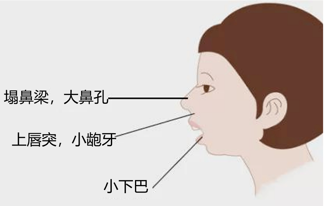 上下嘴唇无法自然闭合,孩子嘴唇肌肉松弛,导致上唇突,小龅牙,塌鼻梁