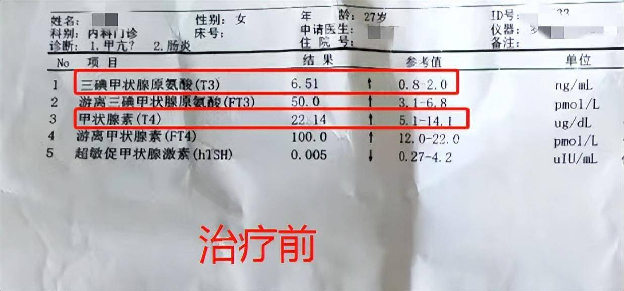 同事眼中的病西施，三分惶恐三分窃喜，检查出甲亢，幸得中医拯救